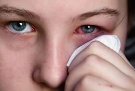 conjuntivitis Aceite de Girasol para la Conjuntivitis