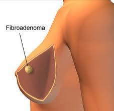  ¿Que es el fibroadenoma?