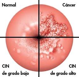 Test Casero para determinar Cáncer de Cuello Uterino