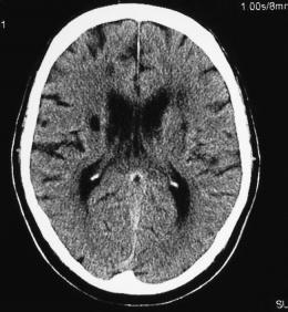 infartos-cerebrales infartos cerebrales Pequeños infartos cerebrales asociados a un mayor riesgo de muerte